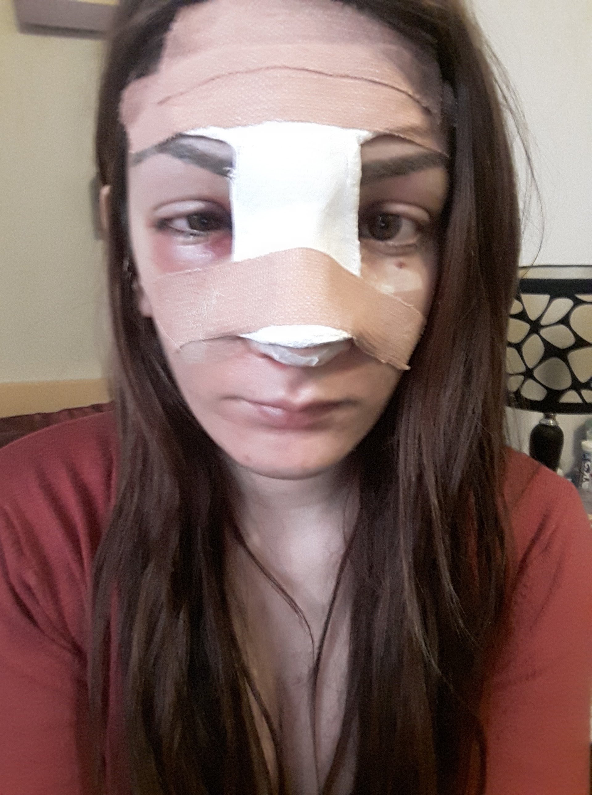 My Rhinoplasty Experience: First Week Recovery, Day 1